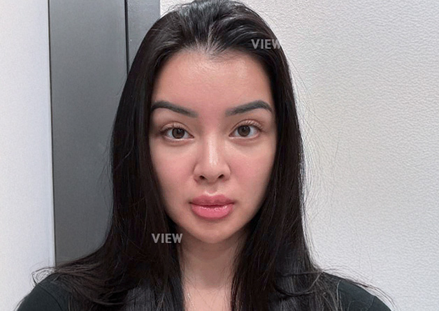 Plastic Surgery in Korea: My Experience at VIEW Plastic Surgery