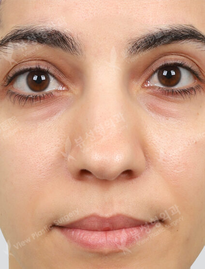 Fraxel, CO2 point removal (1 Month) — After