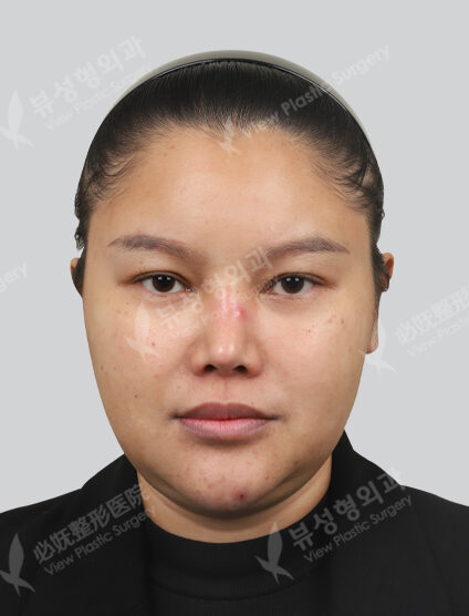Shrink + Contouring Injection + Inflammation Injection + Lip Filler + Rejuran Healer (1 Month) — Before
