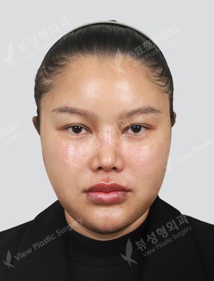 Shrink + Contouring Injection + Inflammation Injection + Lip Filler + Rejuran Healer (1 Month) — After