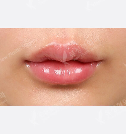 Lip + lip filler (1 Month) — After