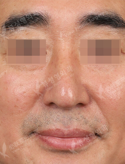 IPL+CO2 (1 Month) — Before