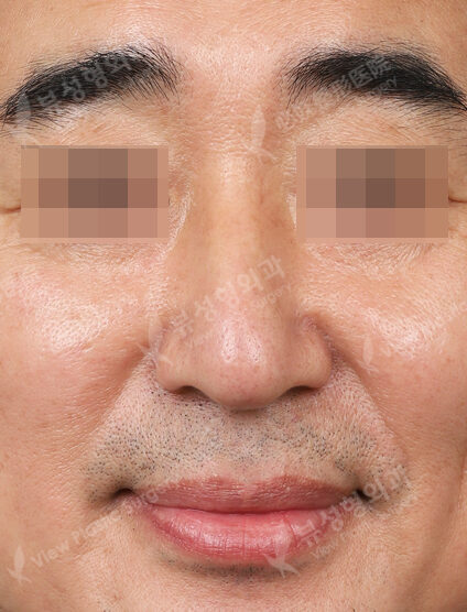 IPL+CO2 (1 Month) — After