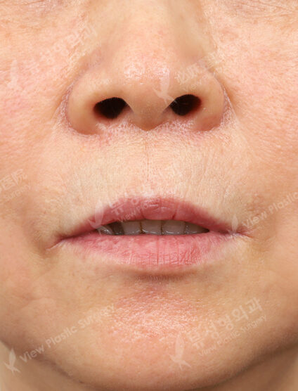 Filler (nasolabial folds, lips) (1 Month) — After