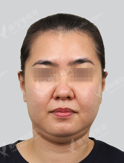 Ulthera + contour injection 3 times + contour toxin (1 Month) — Before