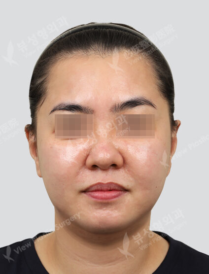 Ulthera + contour injection 3 times + contour toxin (1 Month) — After
