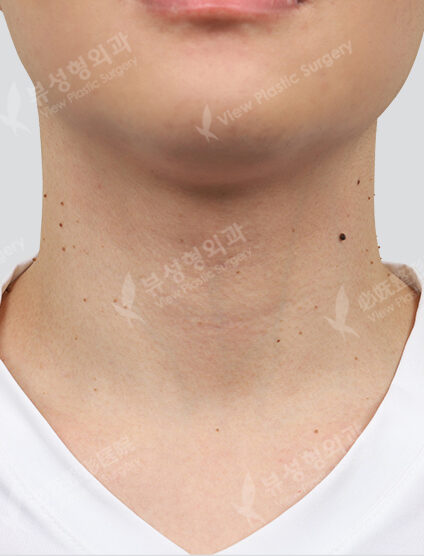 Vivace + Partial Fraxel + PDRN 1 time + Co2 (neck, mouse skin) 1 time (1 Month) — Before