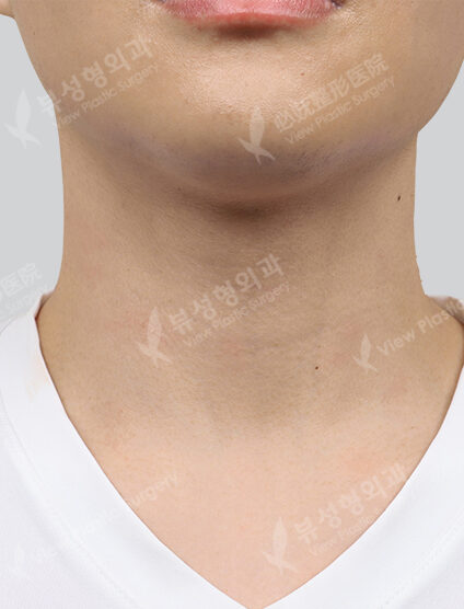 Vivace + Partial Fraxel + PDRN 1 time + Co2 (neck, mouse skin) 1 time (1 Month) — After