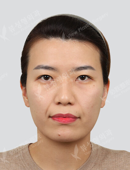Shrink 1 time + F (nasolabial fold) + B (skin) + contour injection 1 time + Co2 (point removal) 1 time (1 Month) — Before