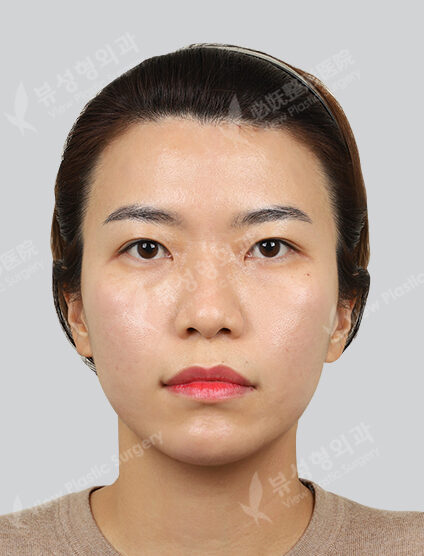 Shrink 1 time + F (nasolabial fold) + B (skin) + contour injection 1 time + Co2 (point removal) 1 time (1 Month) — After
