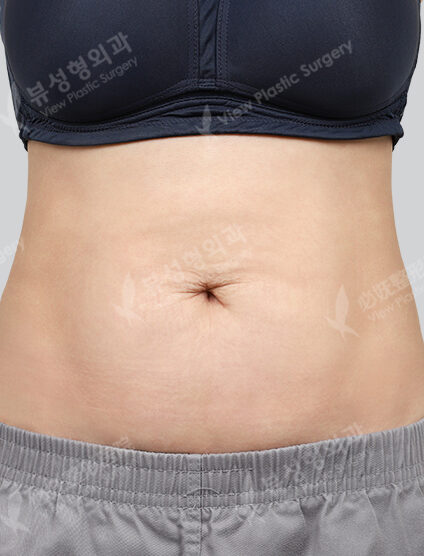 Abdominal Body Shrink + Abdominal Fat Dissolving Injection + High Frequency 3 Times + Abdominal Lifting Botox (1 Month) — Before