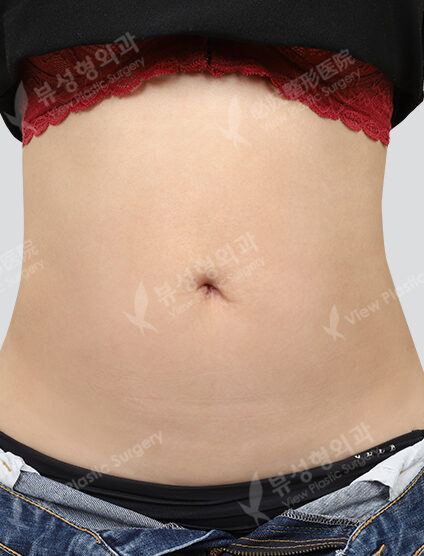 Abdominal Body Shrink + Abdominal Fat Dissolving Injection + High Frequency 3 Times + Abdominal Lifting Botox (1 Month) — After