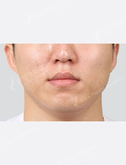 Nose filler, forehead botox (1 Month) — After