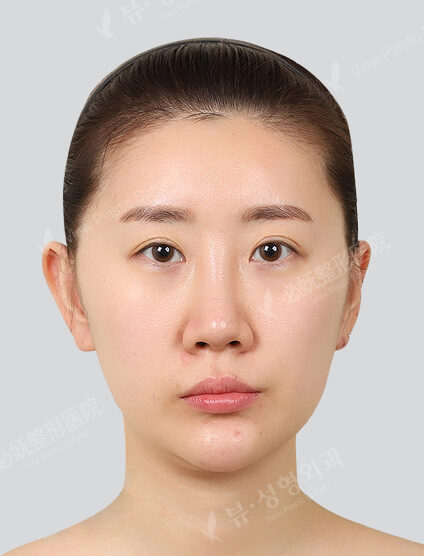 Water glow, whitening focus (1 Month) — Before