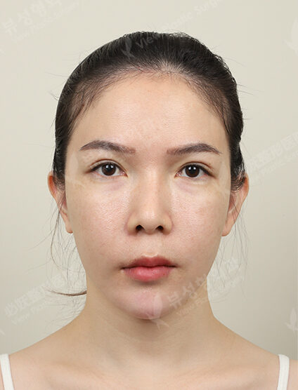 Ulthera (1 Month) — Before