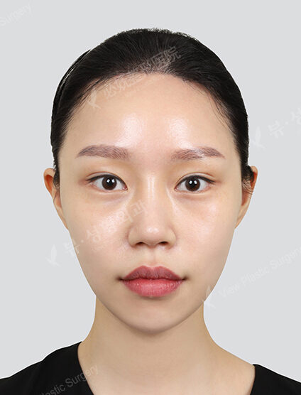 Shrink (1 Month) — After