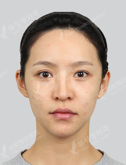 Fraxel, PRP 3 times (1 Month) — Before