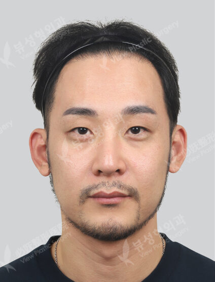 Shrink+Forehead, Botox for forehead (1 Month) — Before