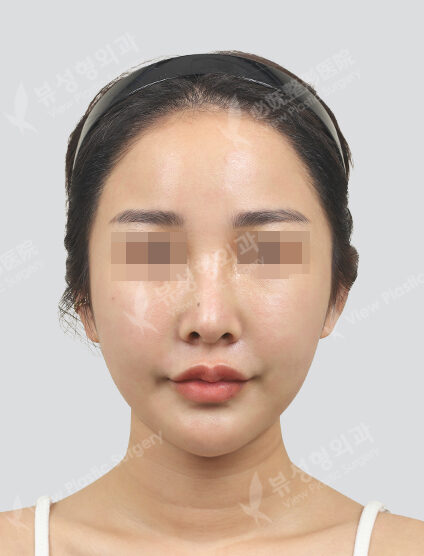 Vivace, PDRN (1 Month) — After