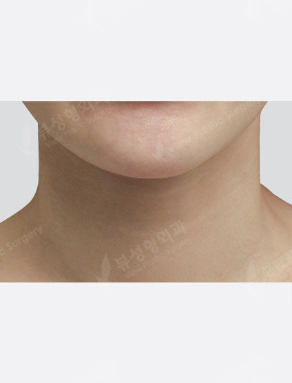 Neck Wrinkle Filler (1 Month) — After