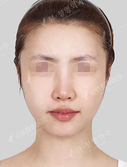 Acculifting (Cheeks , ChinLine)+ Nano Two Jaw+Natural Vline+Zygoma Reduction (Revisional Surgery) (4 Months) — Before
