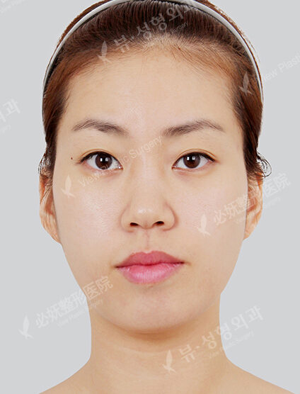 Omega Lifting+Nano Two Jaw+Natural Vline+Zygoma Reduction (5 Months) — Before