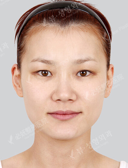 FaceFat Graft — Before