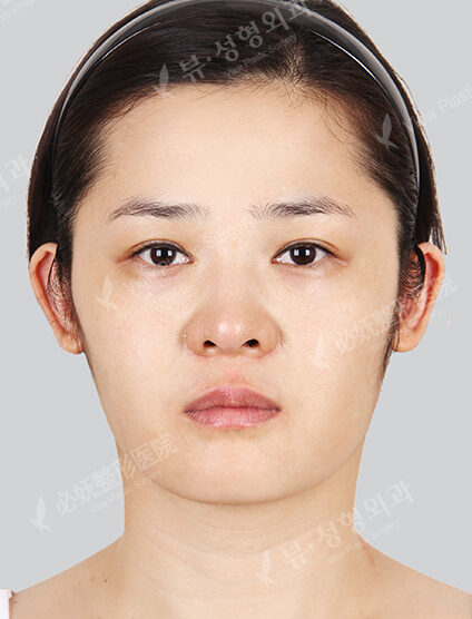 Omega Lifting+Mint Lifting+Fat Graft(1 Month) — Before