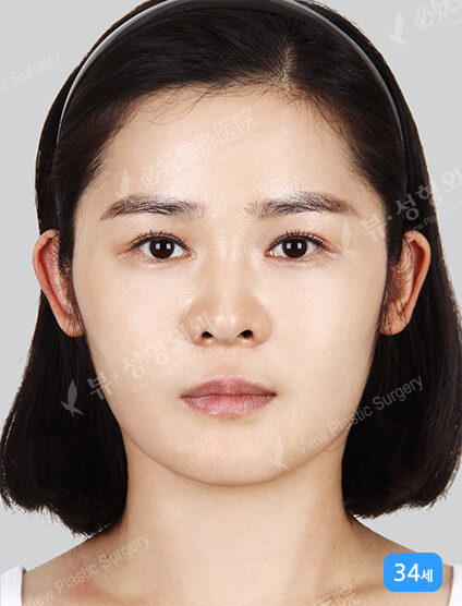 Omega Lifting+Mint Lifting+Fat Graft(1 Month) — After