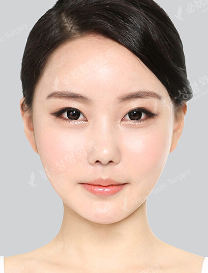 Forehead , Cheeks , Nasolabial Fat Graft — After
