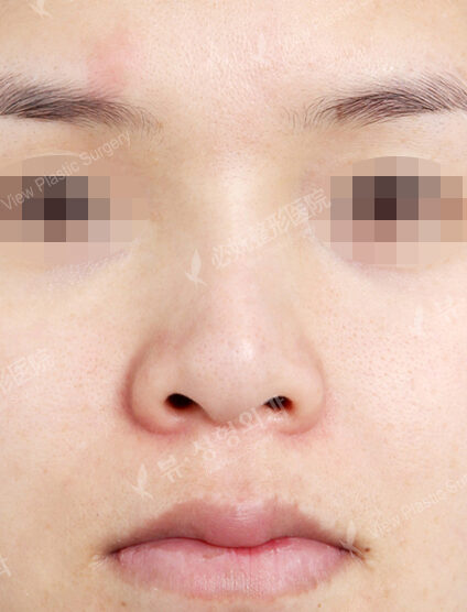 Bulbous Nose (1 Month) — Before