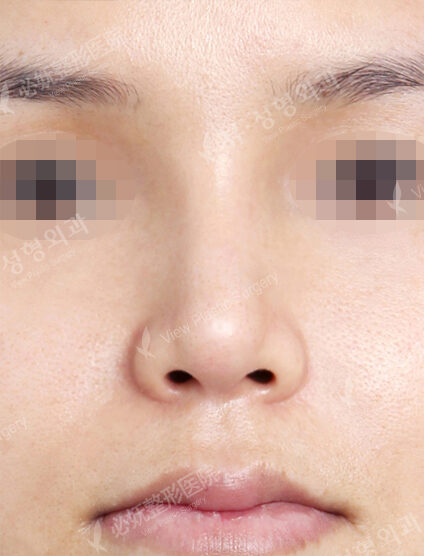 Bulbous Nose (1 Month) — After