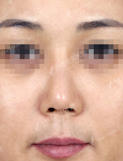 Short Nose (Revisional Rhinoplasty) (1 Month) — Before