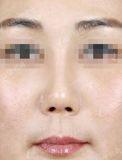 Short Nose (Revisional Rhinoplasty) (1 Month) — After
