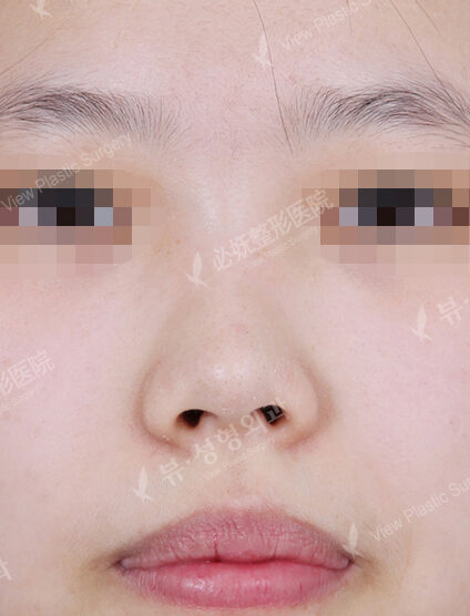 Short Nose (1 Month) — Before
