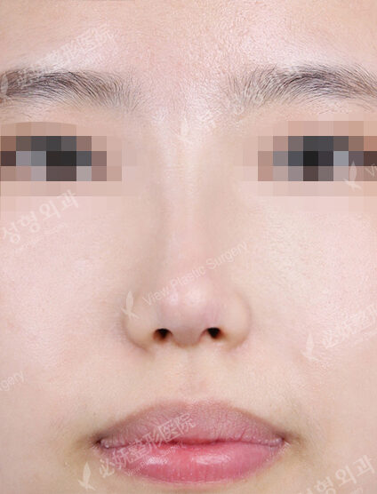Short Nose (1 Month) — After