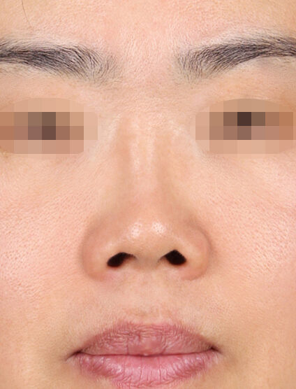 Short Nose (Revisional Rhinoplasty) (1 Month) — Before