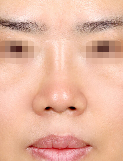 Short Nose (Revisional Rhinoplasty) (1 Month) — After