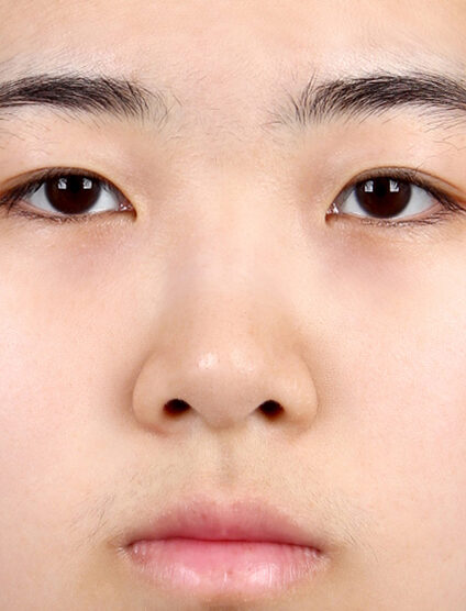 Short Nose (1 Month) — Before