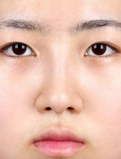 Short Nose (1 Month) — After