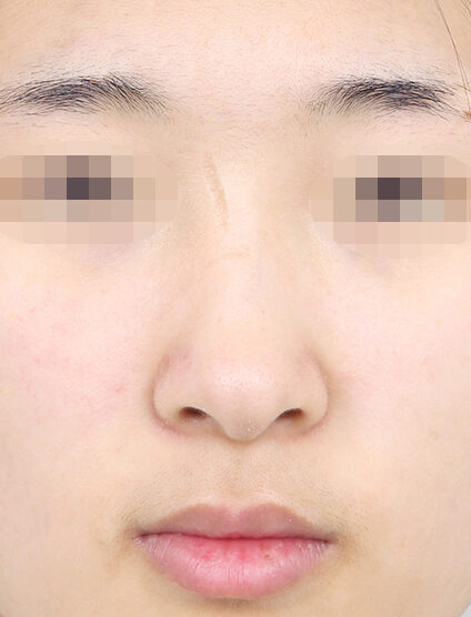 Bulbous Nose (1 Month) — Before