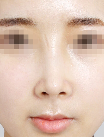 Bulbous Nose (1 Month) — After