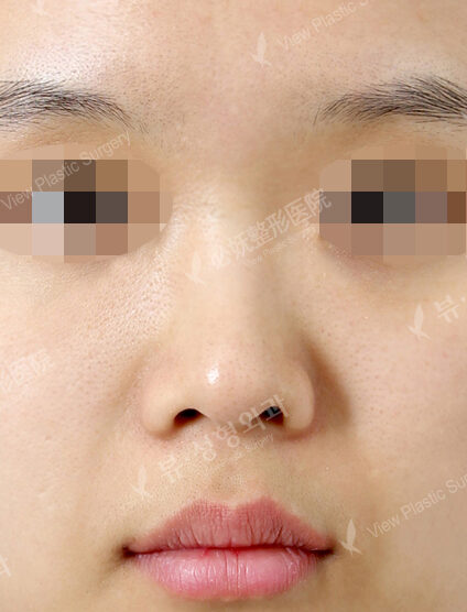 Low Nose (1 Month) — Before