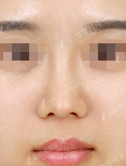 Low Nose (1 Month) — After
