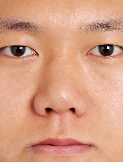T.O.P Surgery_Low Nose (1 Year2 Months) — Before