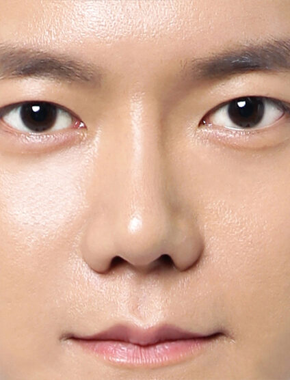 T.O.P Surgery_Low Nose (1 Year2 Months) — After