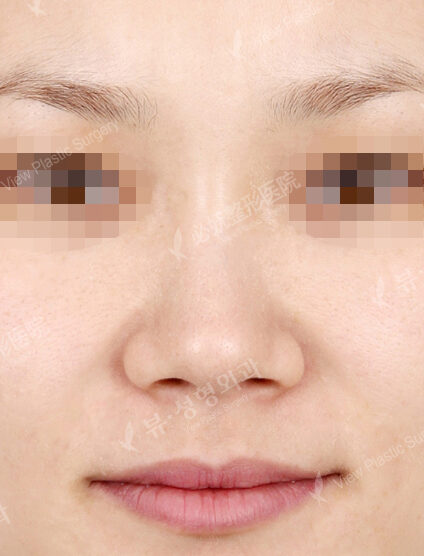 Wide Nose+Weir Reduction (1 Month) — Before
