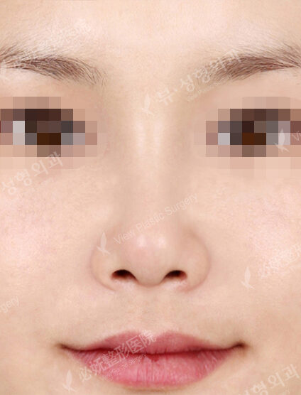 Wide Nose+Weir Reduction (1 Month) — After