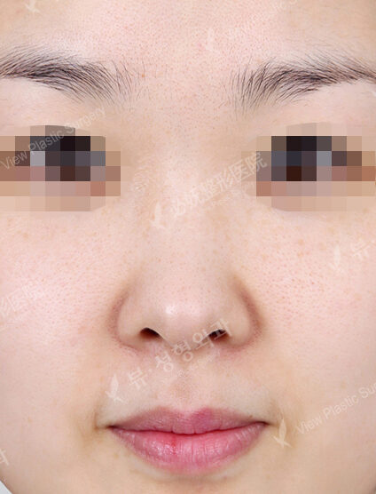 Bulbous Nose (1 Month) — Before