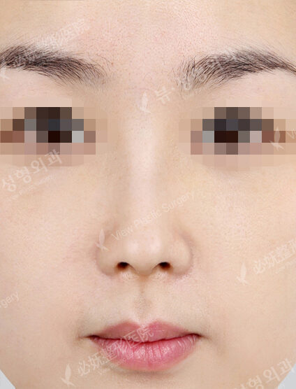 Bulbous Nose (1 Month) — After
